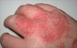 Dermatitis1