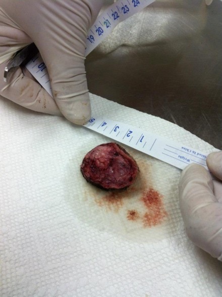 Tumor removed from Bill's leg. We are awaiting the biopsy reports - despite Dr. Berglund's claim that they are benign, no test has yet to prove this. We hope his guess is correct!